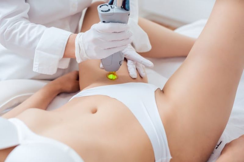 Depilacion laser brasilena